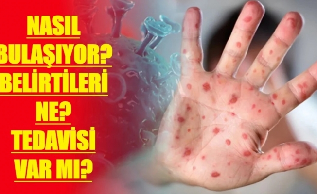 Mpox (Maymun Çiçeği) hastalığı hakkında bilinmesi gerekenler neler!