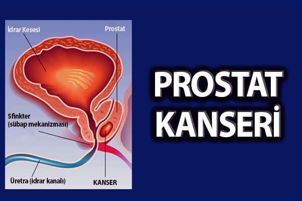 Prostat kanseri hakkında en çok merak edilen 10 soru