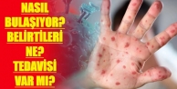 Mpox (Maymun Çiçeği) hastalığı hakkında bilinmesi gerekenler neler!